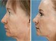 Non-invasive Laser Eye and Facelift: A Case Study