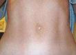 Changing Your Belly Button With Umbilicoplasty