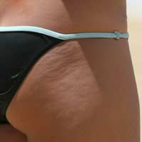 Cellulite Surgery Liposuction Plastic