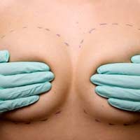 Breast Removal Plastic Surgeon Implants