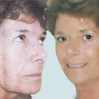 Facelift Twilight Surgery Wake Twilight