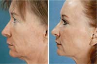 Facelift Eye Non-invasive Confidence