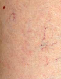 Vein Thread Veins Laser Clinic Thread