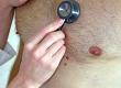 Can Men Have Breast Reduction Surgery on the NHS?
