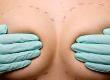 Breast Augmentation Surgery