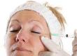 Non-Surgical Procedure: Collagen Injections