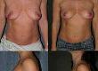 What is the Benelli Breast Lift?