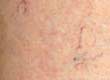 What is Thread Vein Removal?