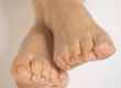 Cosmetic Surgery for Feet
