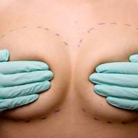 Breast Surgery