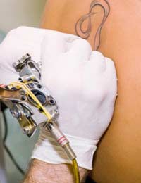 Tattoo Tattoo Removal Ink Skin Surgical