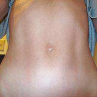 Belly Button Navel Operation