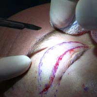 Surgical Treatments