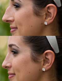 Nose Nose Job Revision Rhinoplasty