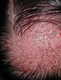 Hair Transplant Follicular Unit