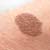 Birthmarks and Removal